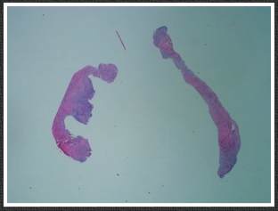 diastolic pressure trap 4