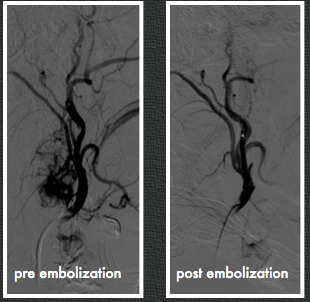 embolization