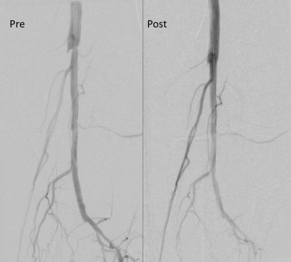 prepost sfa endpoint