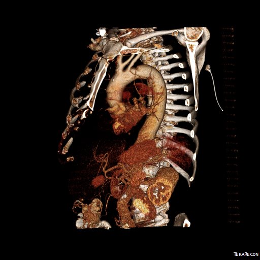 Bovine arch in 3DVR view on TeraRecon Aquarius reconstruction. 
