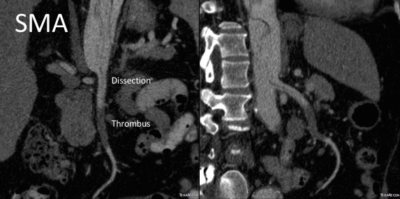 Figure SMA thrombus with dissection
