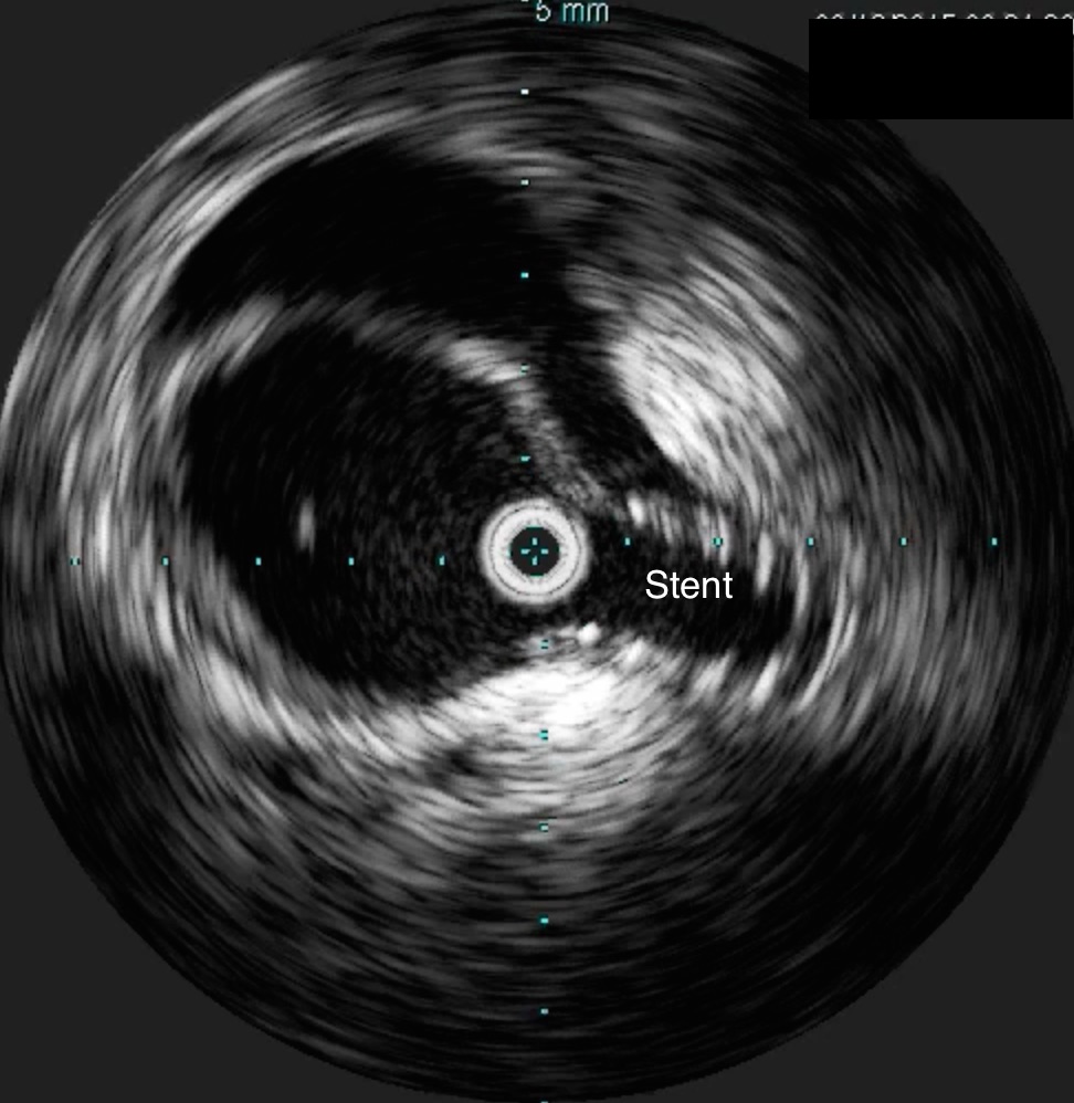IVUS after SMA stent