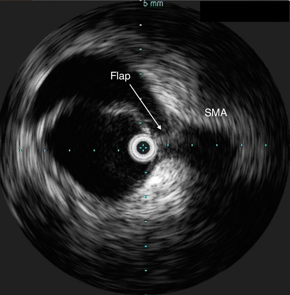 IVUS confirming true lumen access, and dissection flap compressing SMA origin