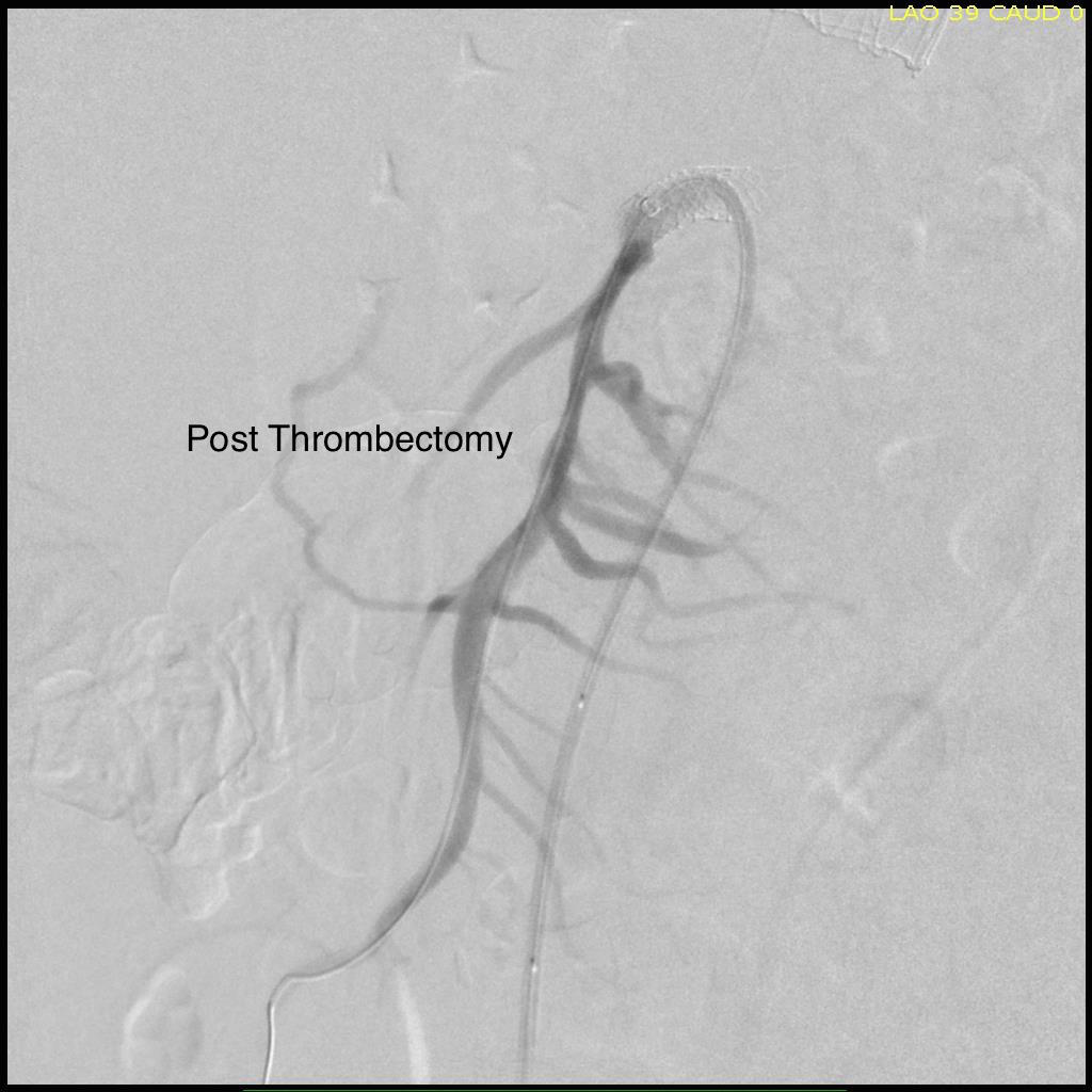 Post thrombectomy SMA