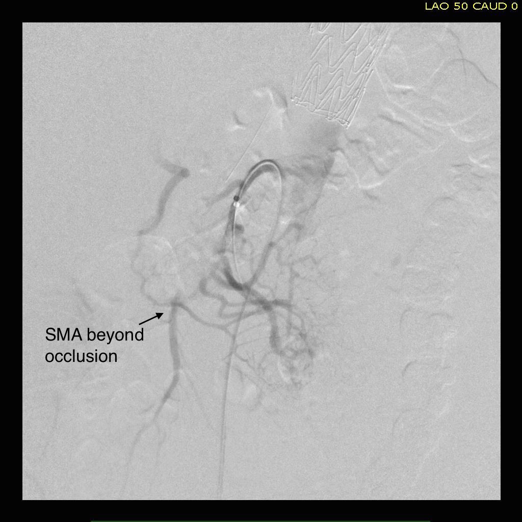 SMA beyond occlusion