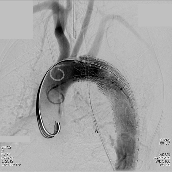 aortogram post stent trauma