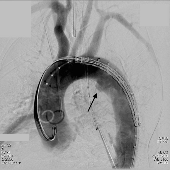 aortogram trauma close arch