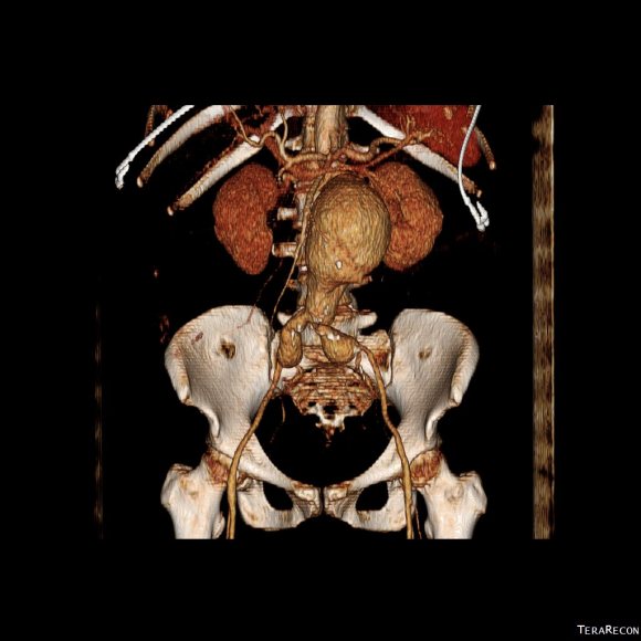 CTA AAA with pancreatitis_1