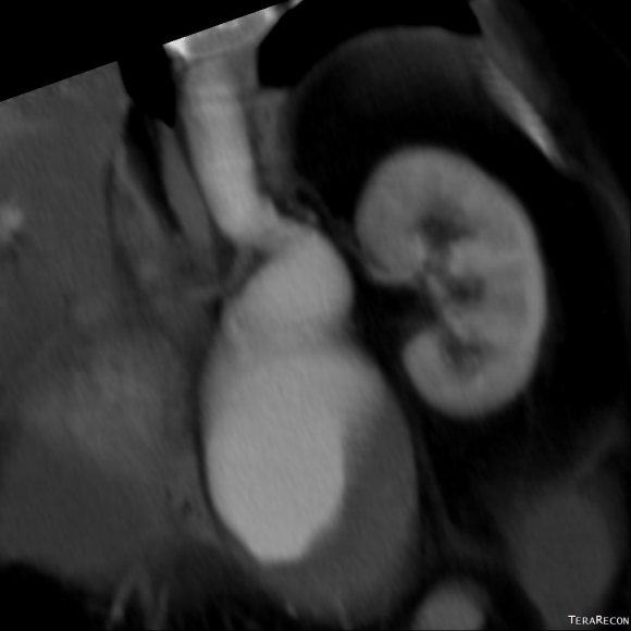 Greater than 90 degree neck angulation