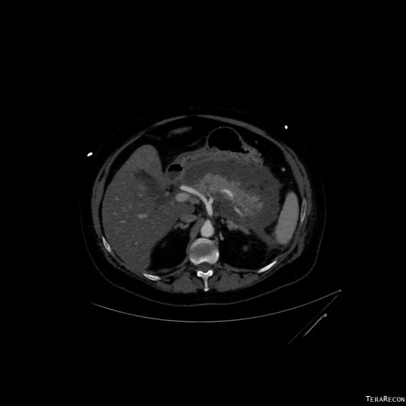 Pancreatitis with surrounding retroperitoneal fluid leak