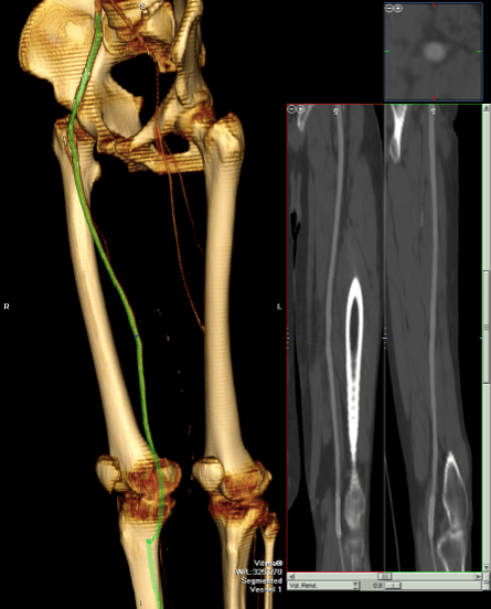 CTA post oblique with center line