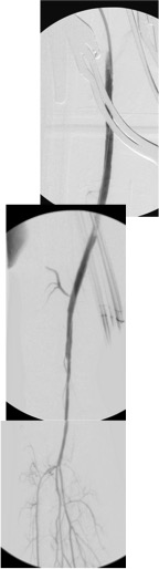 post angio composite