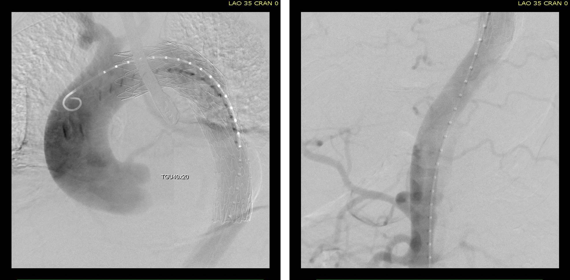Post-Stent aortography