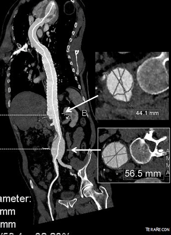 6 month CTA imaging