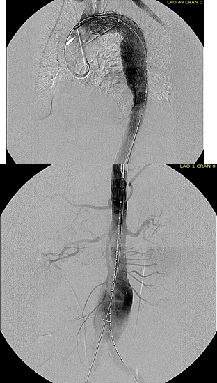 completion TEVAR.png