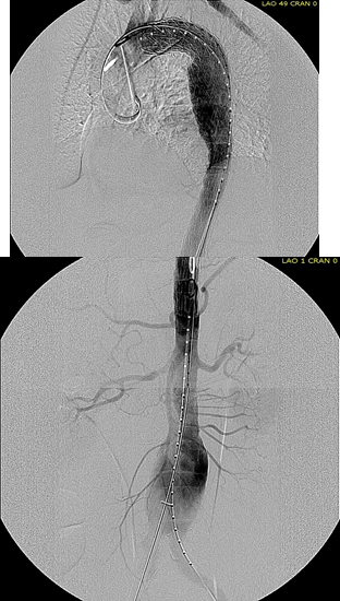 completion TEVAR.png