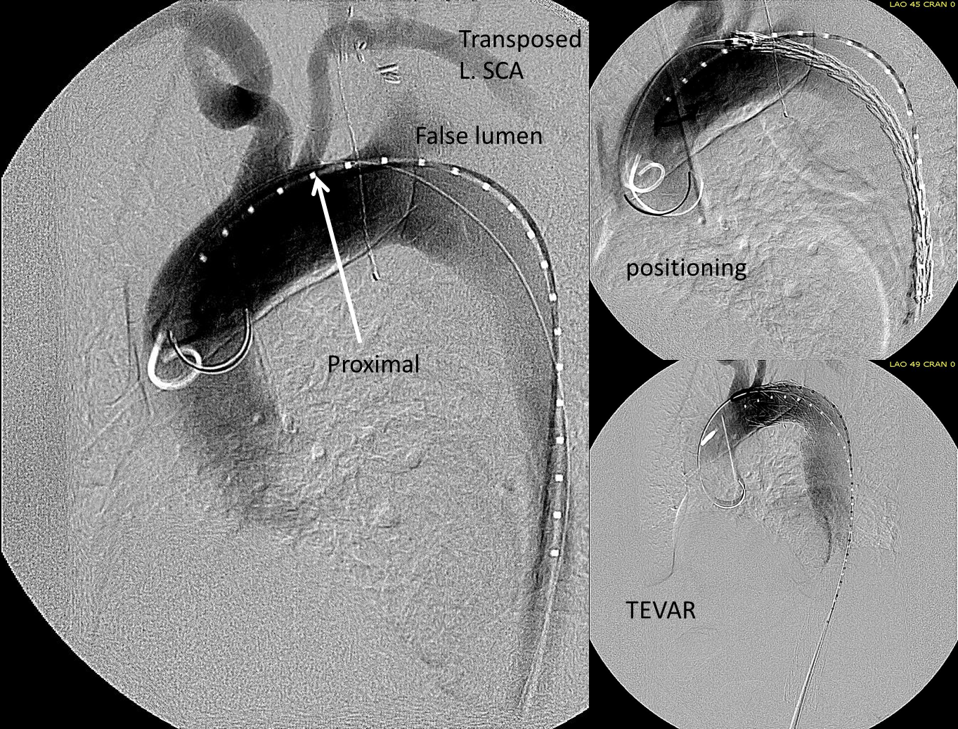 TEVAR with carotid SCA transposition