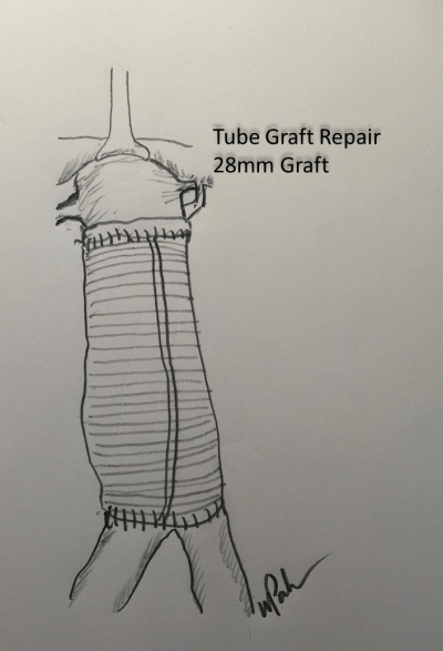 tube graft