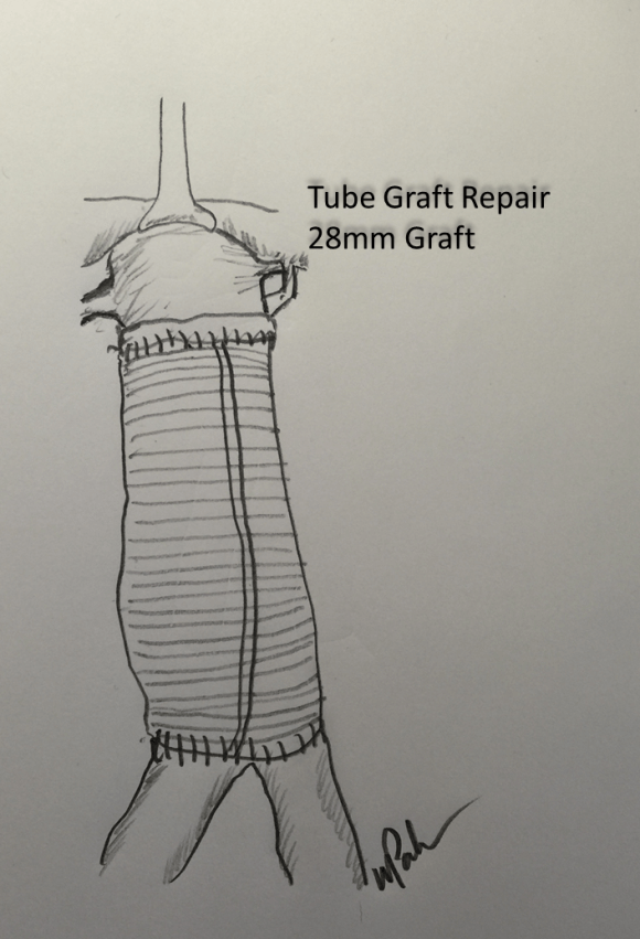 tube graft