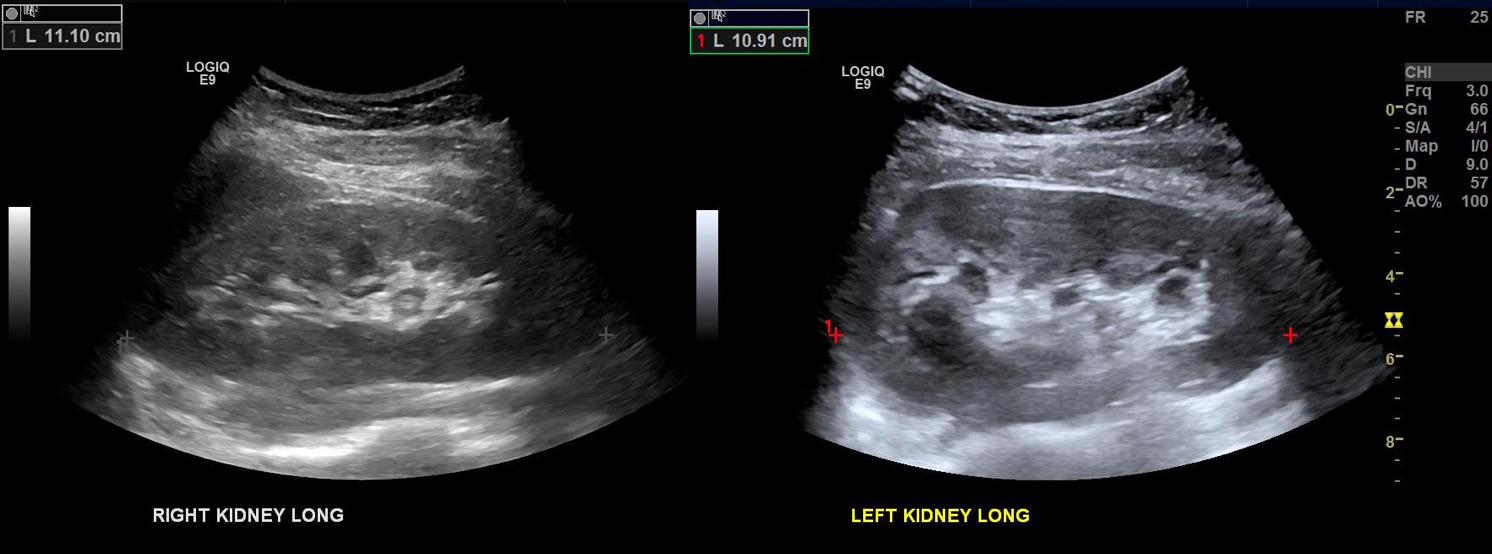 Duplex kidneys bmode