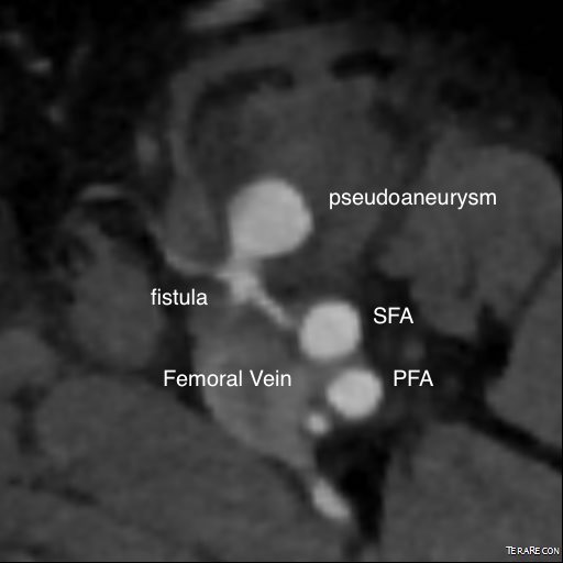 axial CTA avf pseudo