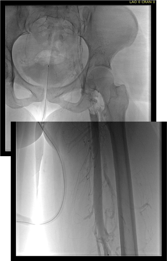 femoral-vein-pre-tpa