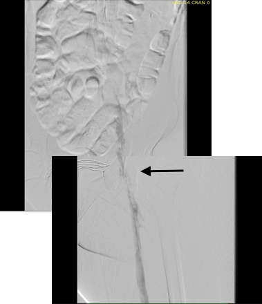 post-lysis-cfv-occluded