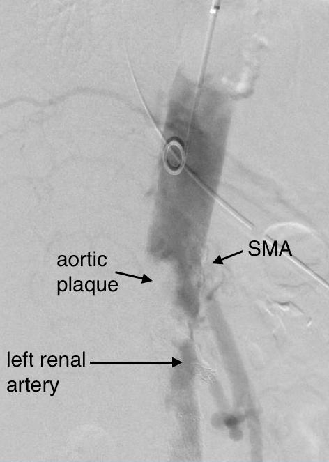 preintervention-aortogram