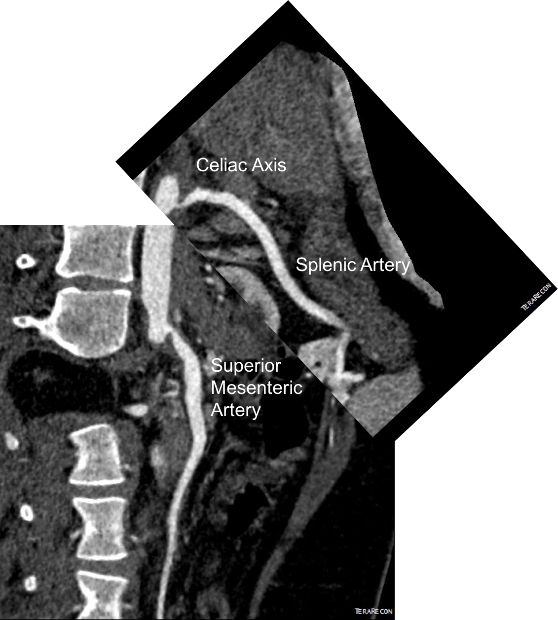 precenterlineCA and SMA.png
