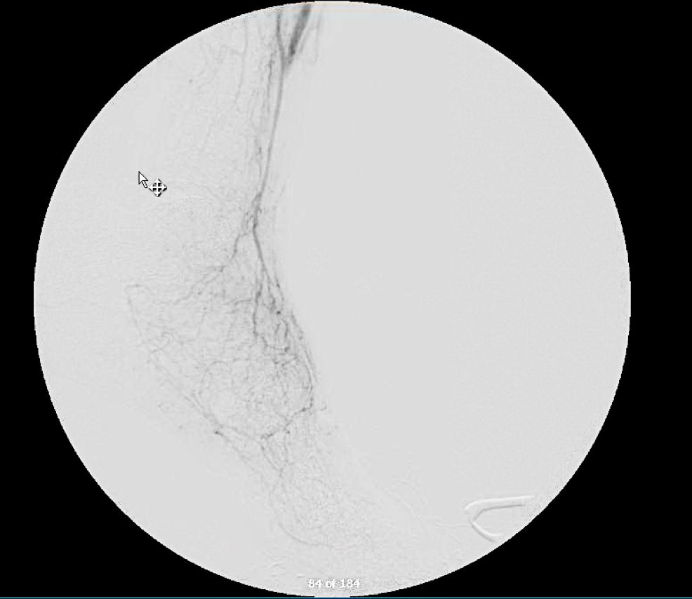 completion angiography.png