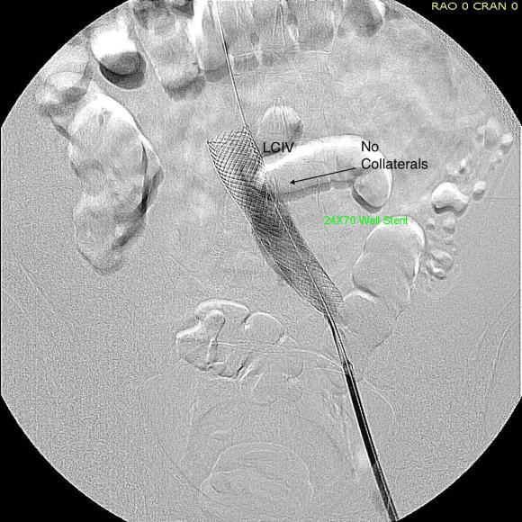 post-intervention-angio