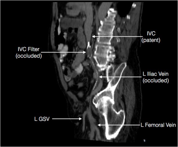 Annotated L iliocaval Centerline Preop CT.jpg