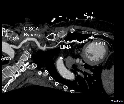 centerline postop.jpg