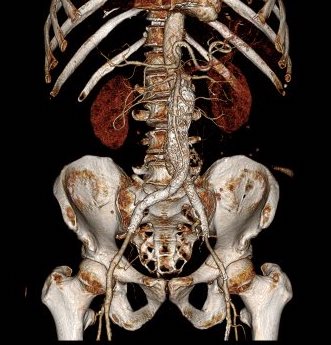 post CTA EVAR-ENDORE