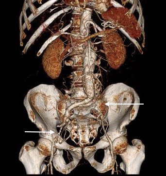 preop CTA EVAR-ENDORE.jpg