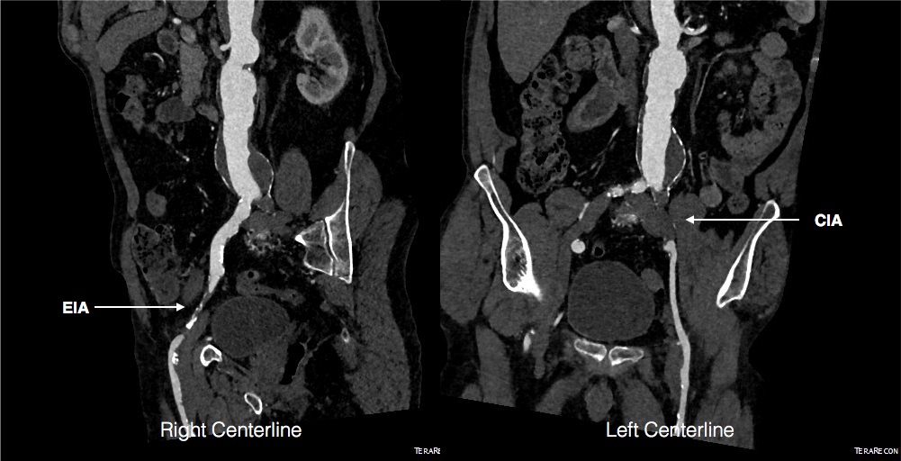 Preop left and right centerlines EVAR-ENDORE.jpg