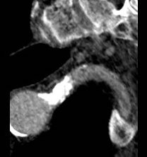preop sca occlusion.jpg