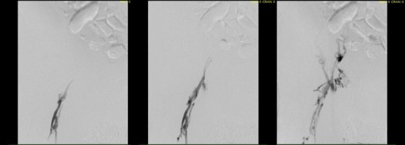 right initial venogram