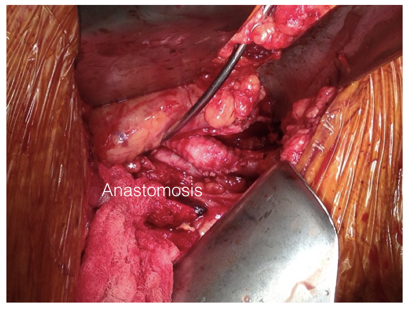 EndoRE in graft infection.005.jpeg