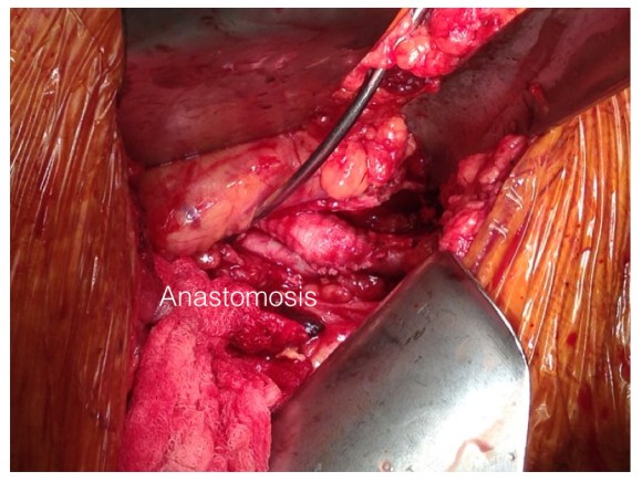 EndoRE in graft infection.005.jpeg