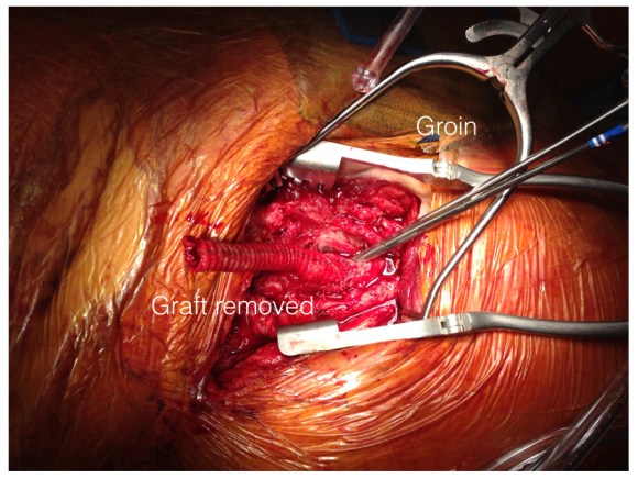 EndoRE in graft infection.006