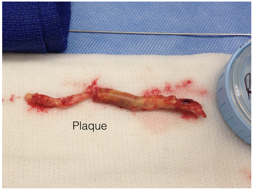 EndoRE in graft infection.008