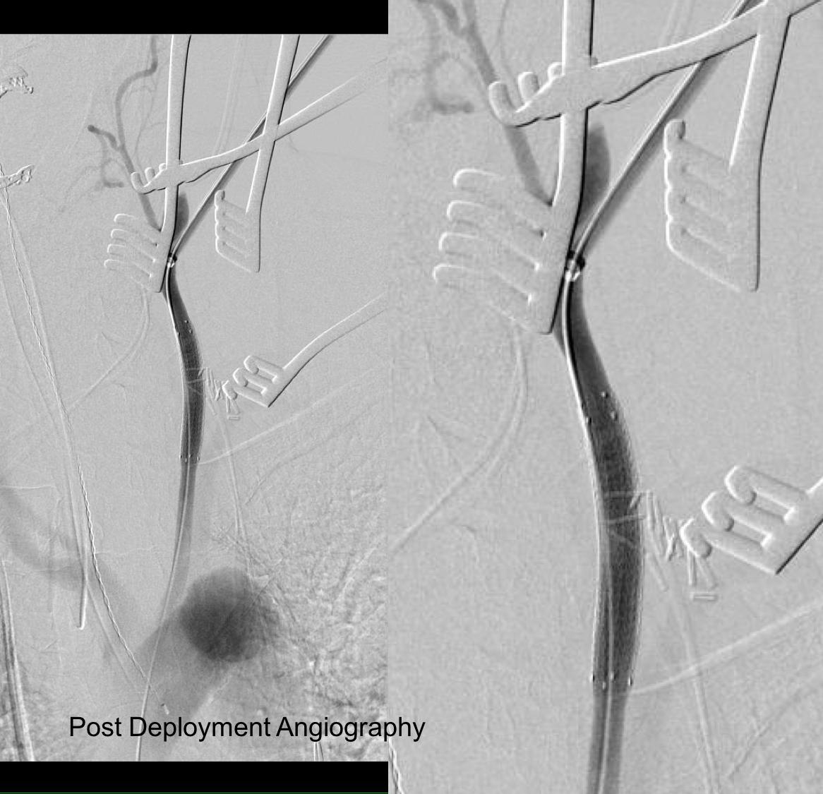 post deployment angiography.png