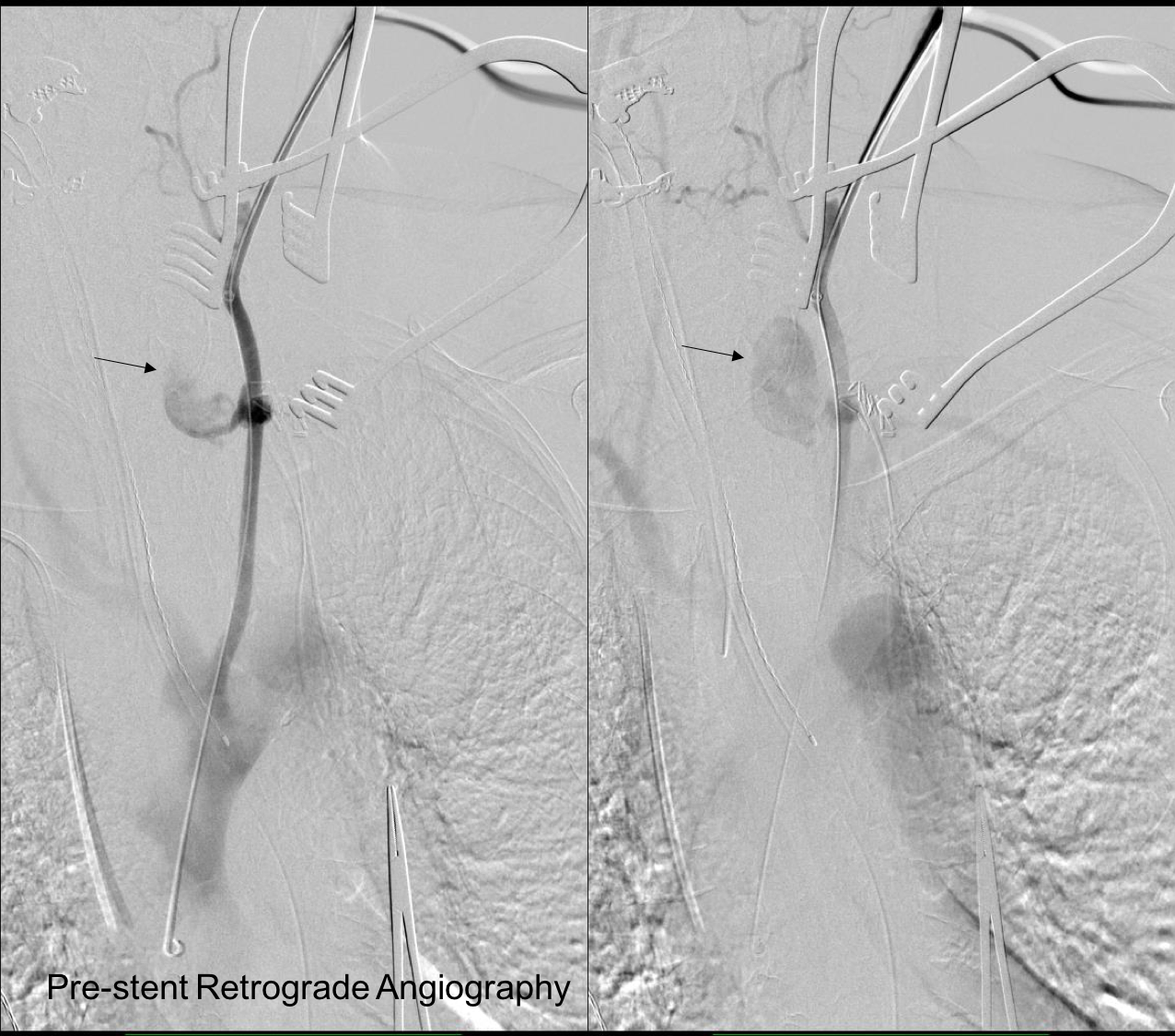 prestent angiography.png
