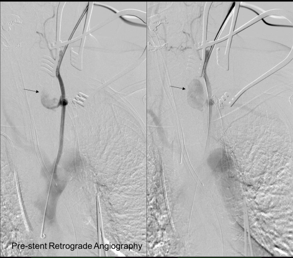 prestent angiography.png