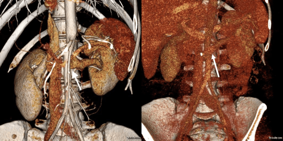 pre and post ctv comparison.png