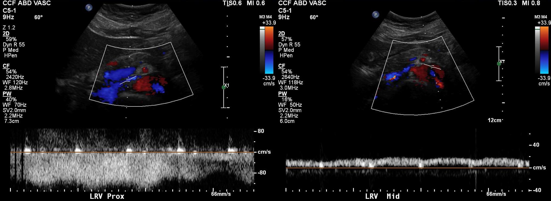 PREOP DUPLEX DOPPLER.png