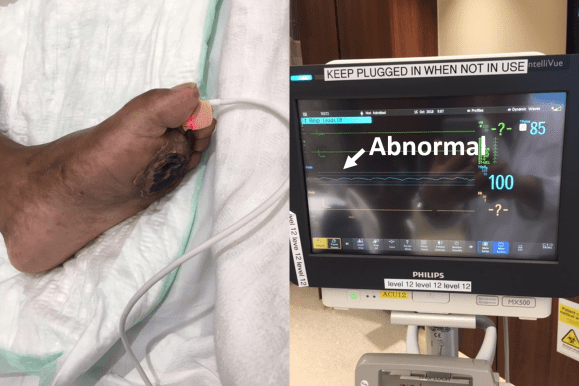 digital ppg foot.png