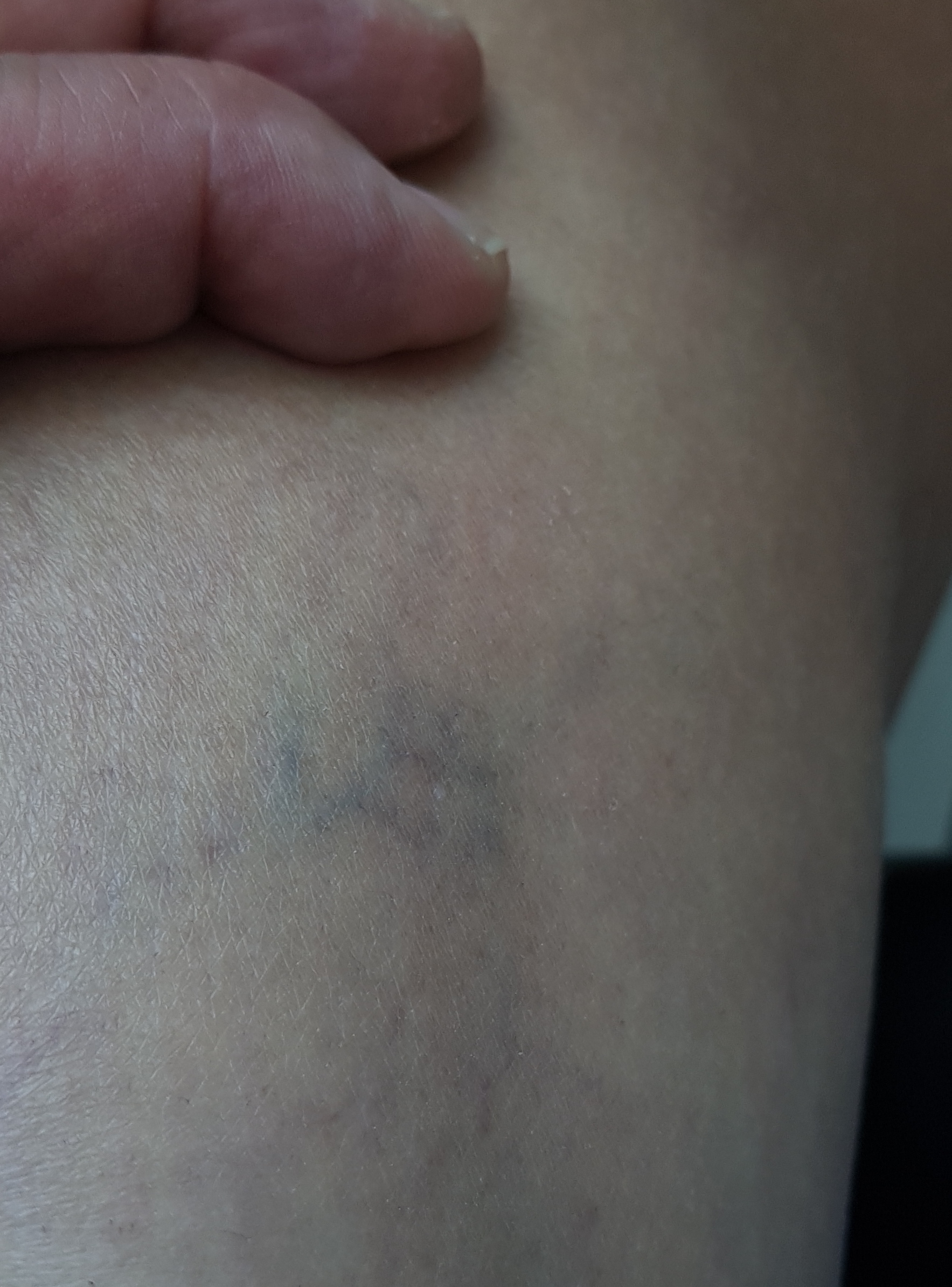 my spider vein