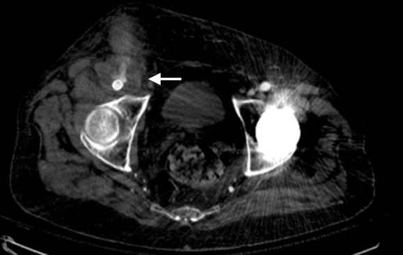 CT scan pseudoaneurysm virvilis